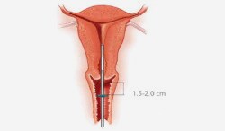 While holding the slider in the furthest position, advance the inserter through the cervix until the flange is approx. 1.5 - 2.0 cm from the uterine cervix.