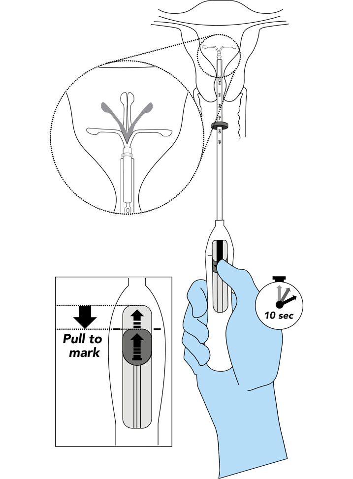 Visual of opening the arms