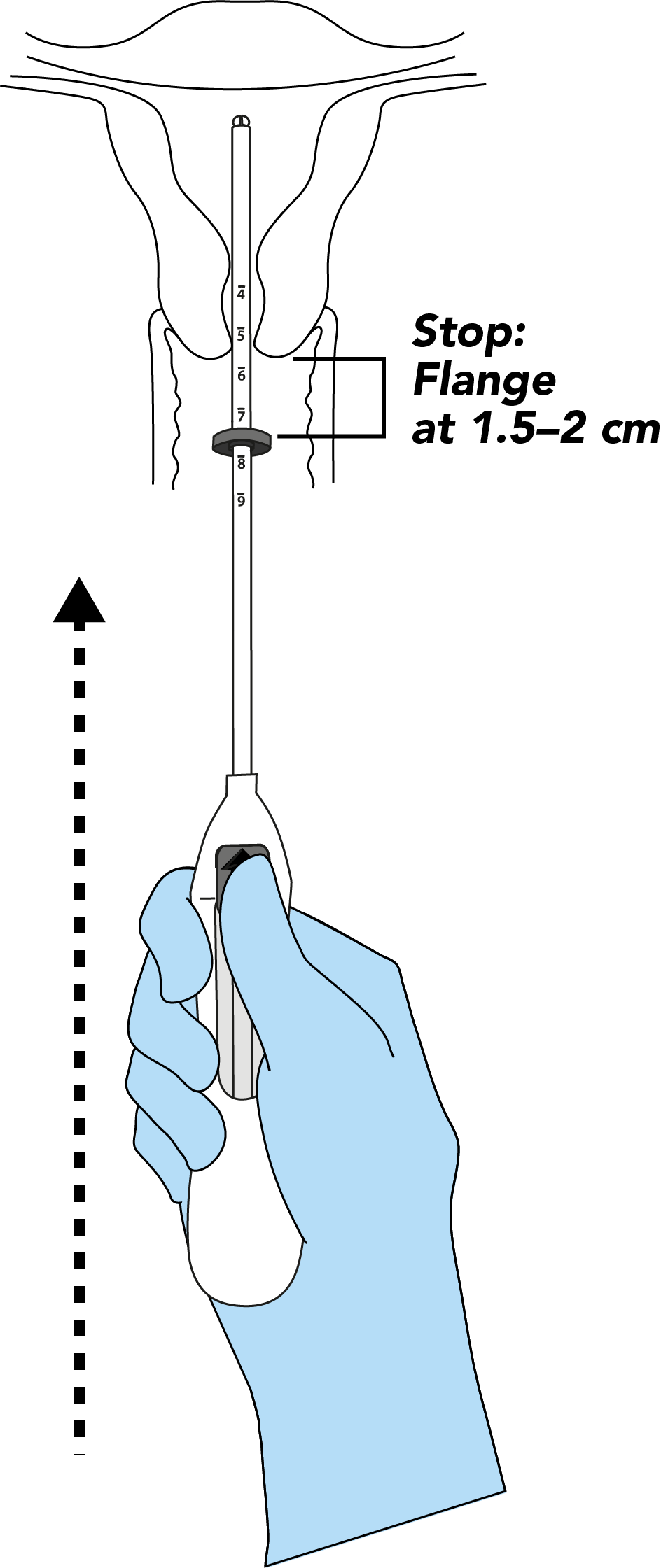 Visual of advancing the inserter
