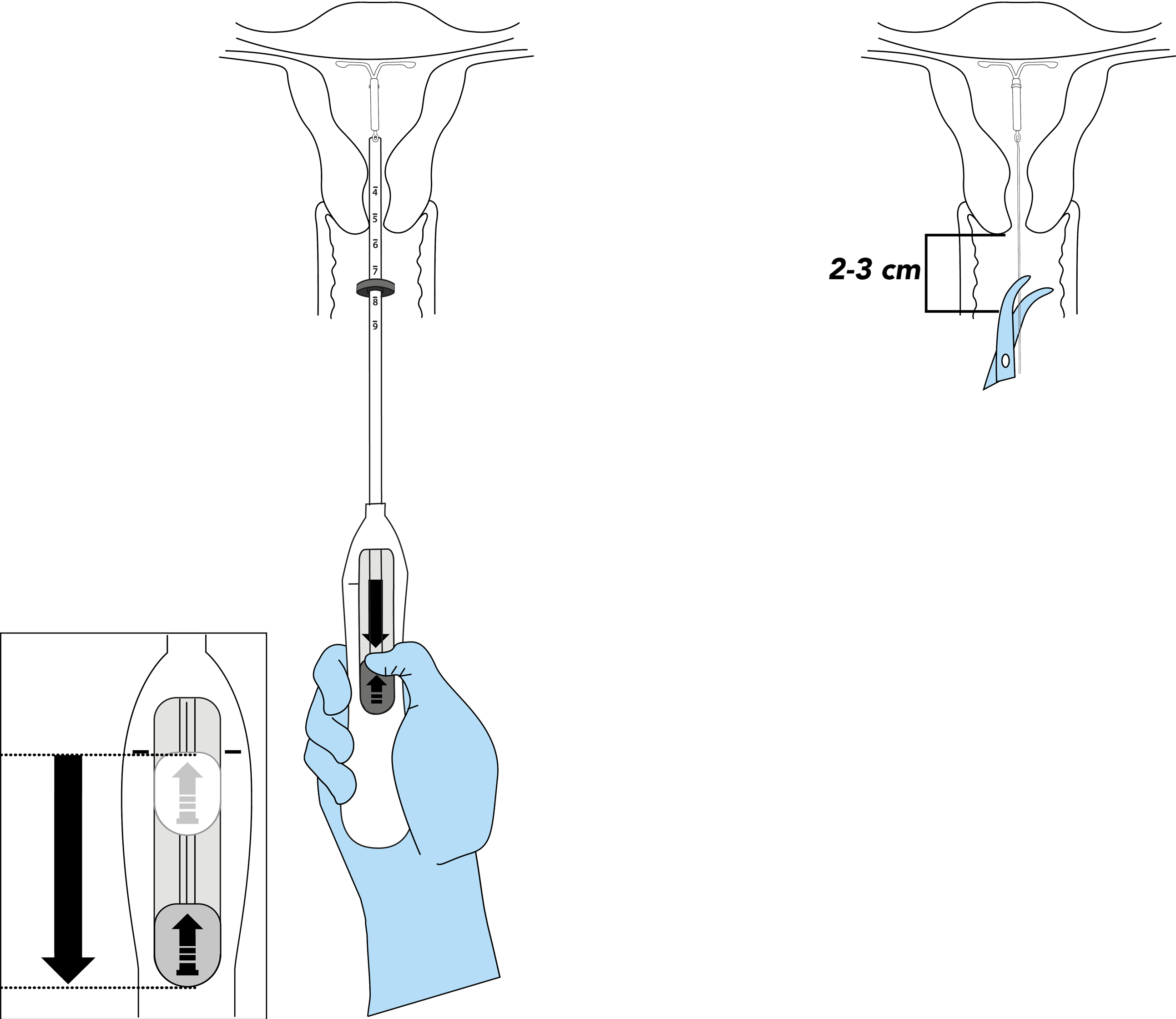 Visual of withdrawing the inserter