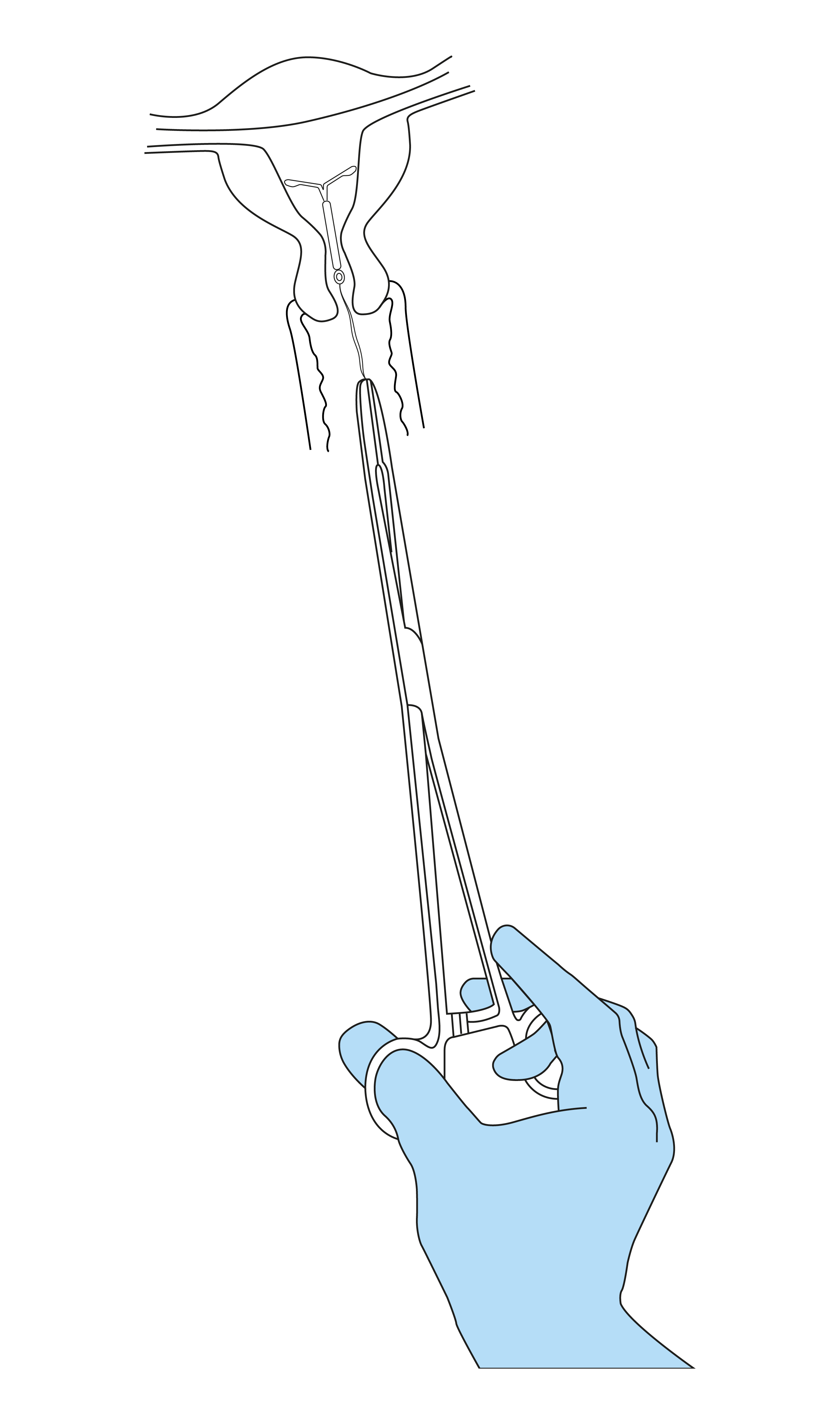 IUS removal / replacement